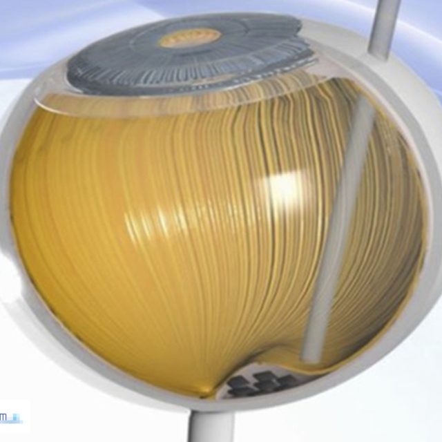 Було встановлено перший штучний імплантат при сухій віковій дегенерації макули