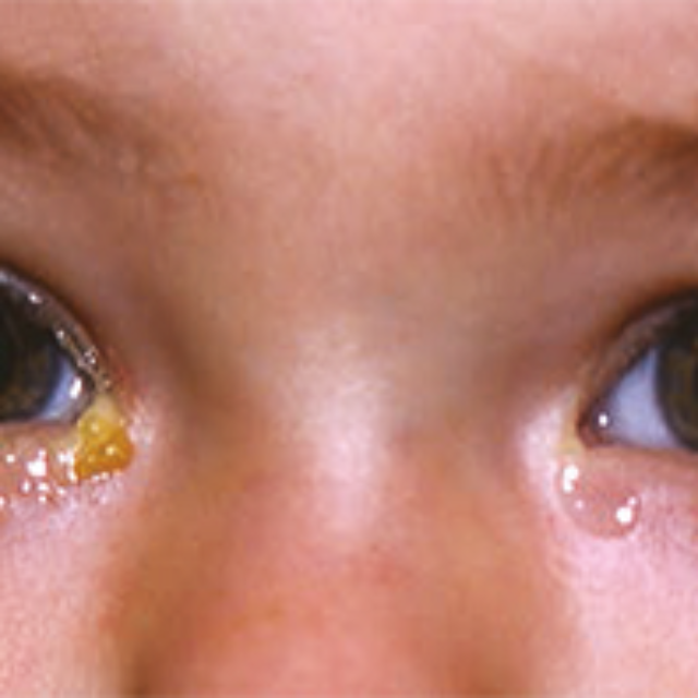 Чи впливає тактика ведення вагітної на вроджену обструкцію нососльозового каналу?