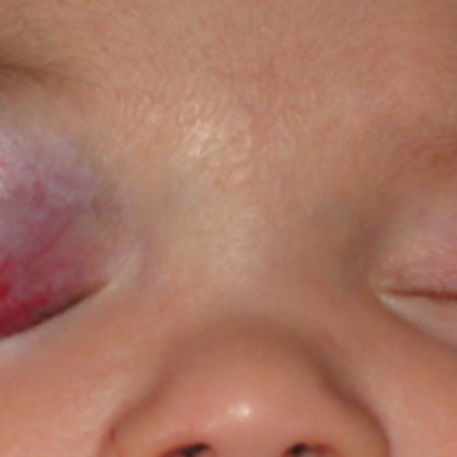 Клінічний випадок: дівчинка 4-х місяців з оклюзивним ураженням судин правої верхньої повіки