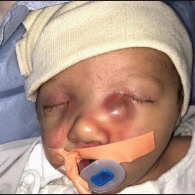 Клінічний випадок: двосторонні синюшні утворення