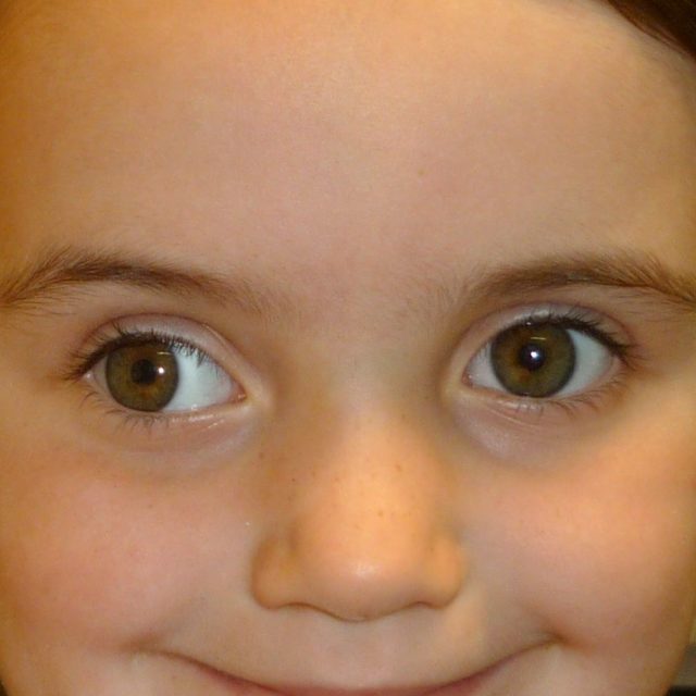 Частота реоперацій серед пацієнтів з дитячою екзотропією