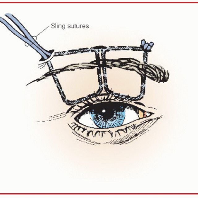 Техніка подвійного ромбоїдного шва при вродженому птозі