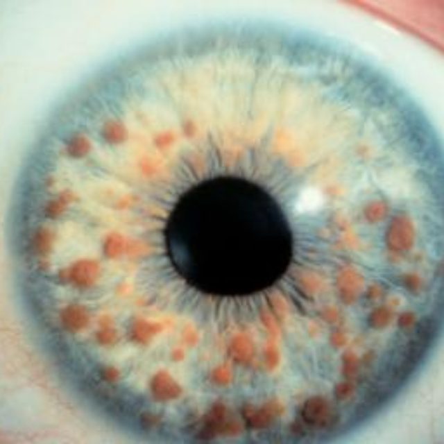 Нейрофіброматоз і ген дикого типу NF1