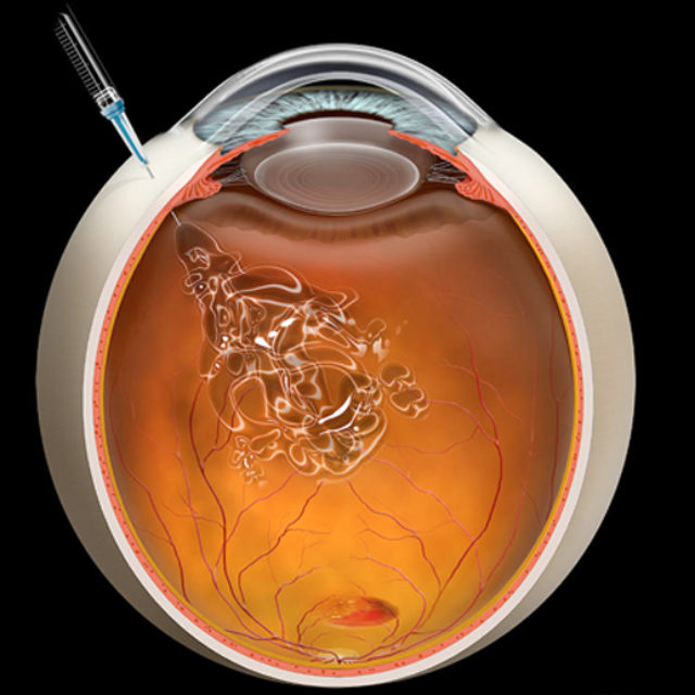 Ятрогенні ураження кришталика, спричинені інтравітреальними ін’єкціями