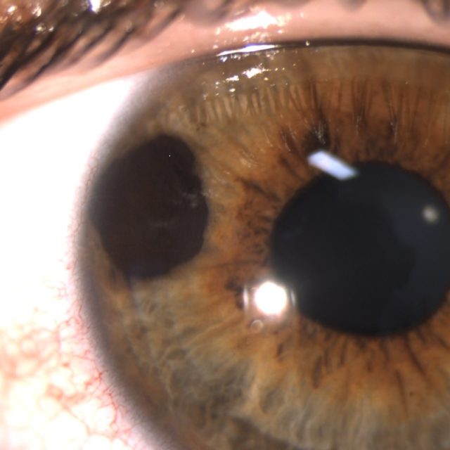 Пембролізумаб як перша лінія терапії метастатичної увеальної меланоми