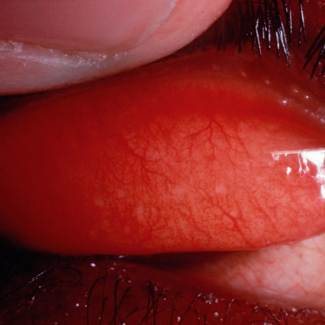 Частота уражень очей хламідіями підвищується після припинення масового використання азитроміцину