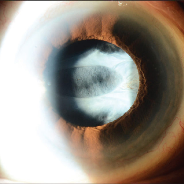 Декілька факторів, які слід враховувати при лікуванні увеальної катаракти у дітей