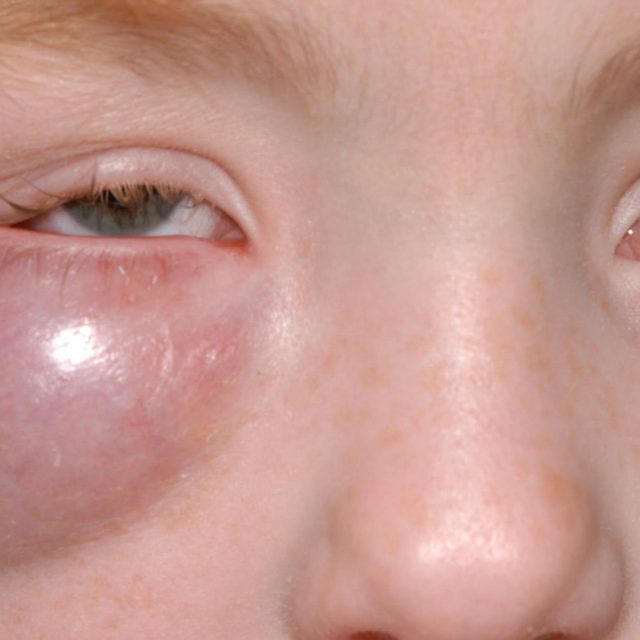 Довгострокові результати мультидисциплінарного підходу до лікування орбітального целюліту у дітей