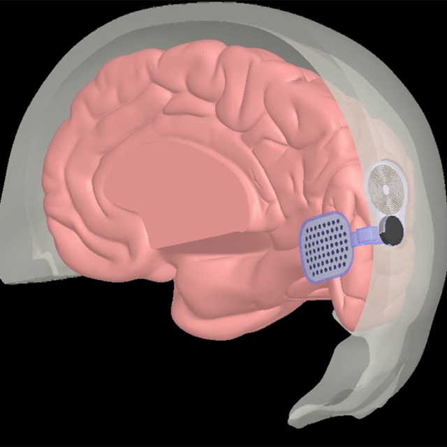 Сліпим пацієнтам, яким було встановлено кортикальний протез Orion, повідомили про функціональні покращення
