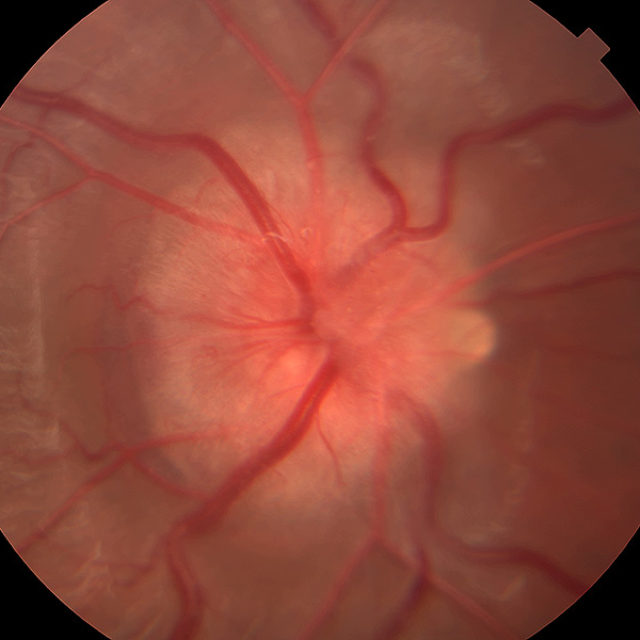 Дослідження невриту зорового нерву у дітей