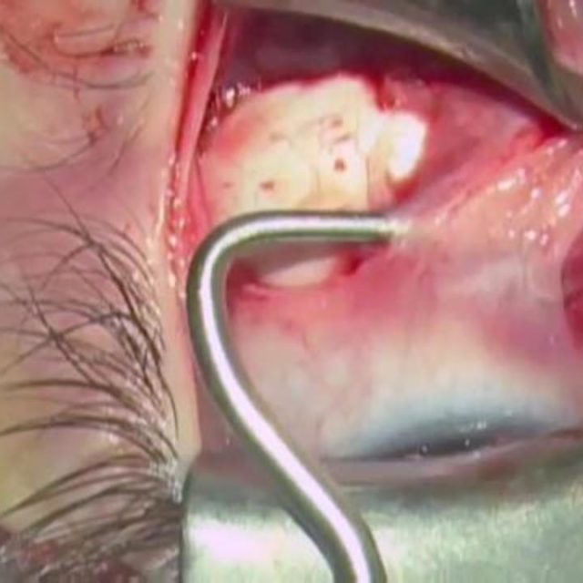 Відео: Фаден-операція нижнього косого м’яза – нова техніка послаблення