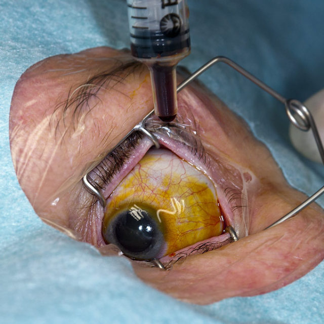 Інстиляція 5% крапель Повідон-йоду під час операцій у дітей може спричинити розвиток апное