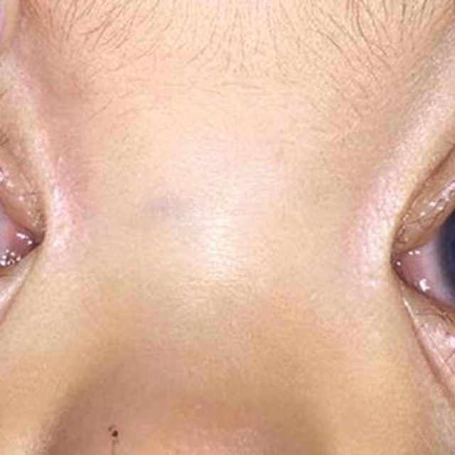 Довгострокові результати гостроти зору при різних типах первинної вродженої глаукоми