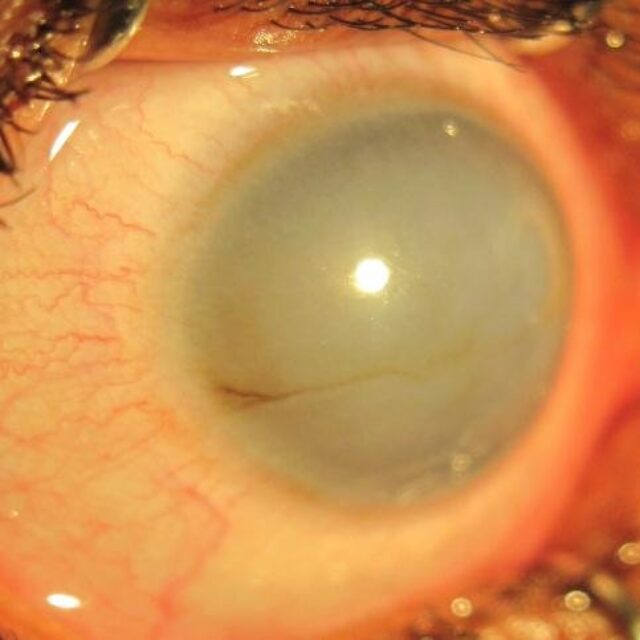 Десцеметова ендотеліальна кератопластика як метод лікування вродженої спадкової ендотеліальної дистрофії