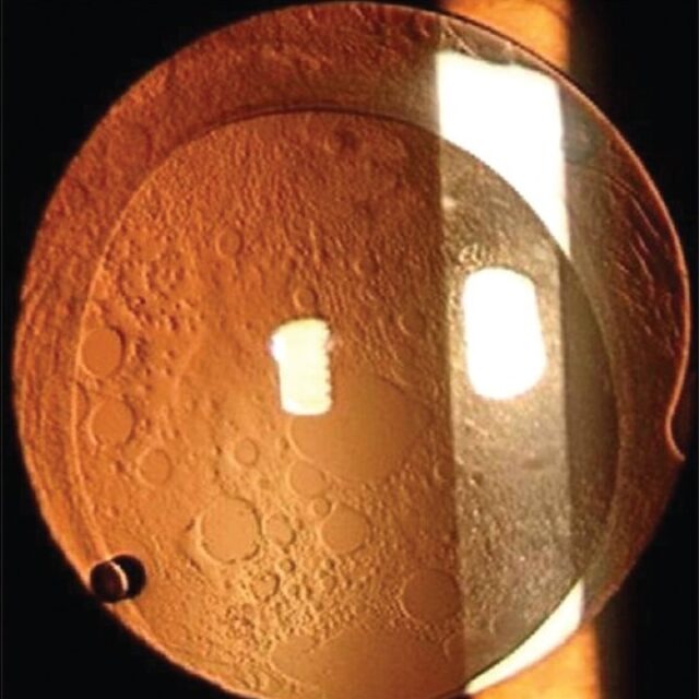 Нова багатообіцяюча техніка для попередження помутніння задньої капсули у дітей