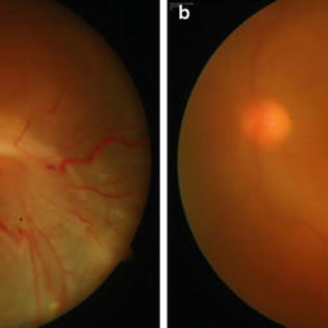 Симпатична офтальмія у дітей: наймасштабнійший аналіз 20-річних даних