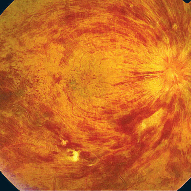 Нові очні краплі, які допоможуть врятувати зір при оклюзії центральної вени сітківки