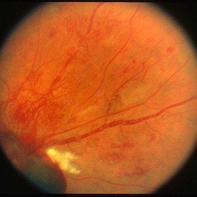 Гліколітичні метаболіти можуть мати великий вплив на неоваскулярні захворювання сітківки