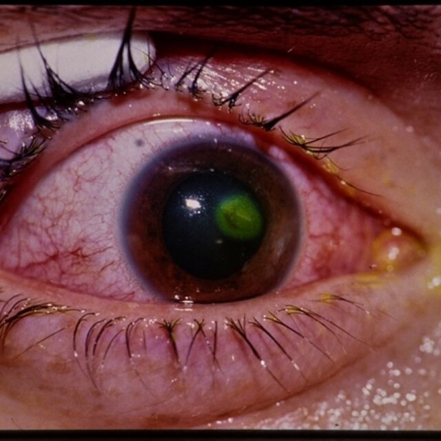 Сучасний підхід до менеджменту перфорацій рогівки