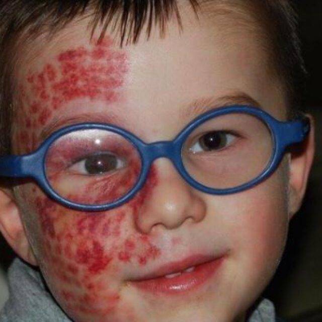 Чи ефективна гоніохірургія у пацієнтів із глаукомою, пов’язаною із синдромом Стерджа-Вебера?