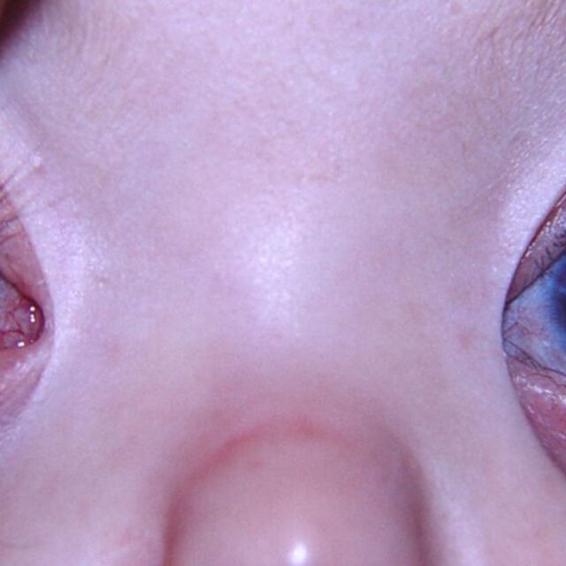 Коротко про інфекційний кератит у дітей: особливості діагностики та лікування