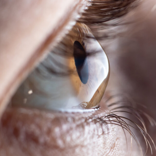 Ефективність застосування додаткової рогівкової тканини для лікування кератоконусу