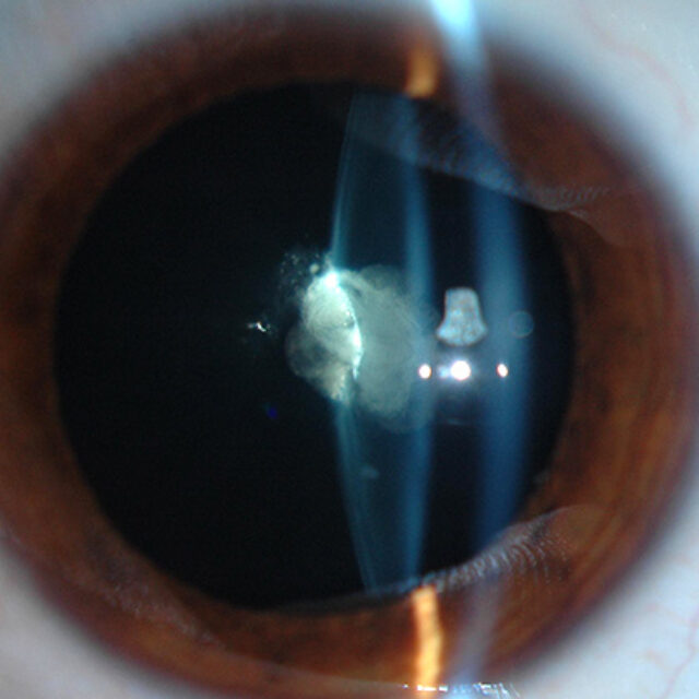 Вторинна імплантація ІОЛ у дітей: зараз чи пізніше?