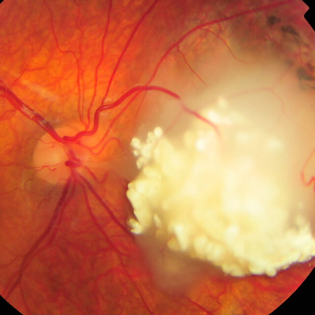 Потенціал біопсії рідини передньої камери ока для менеджменту ретинобластоми