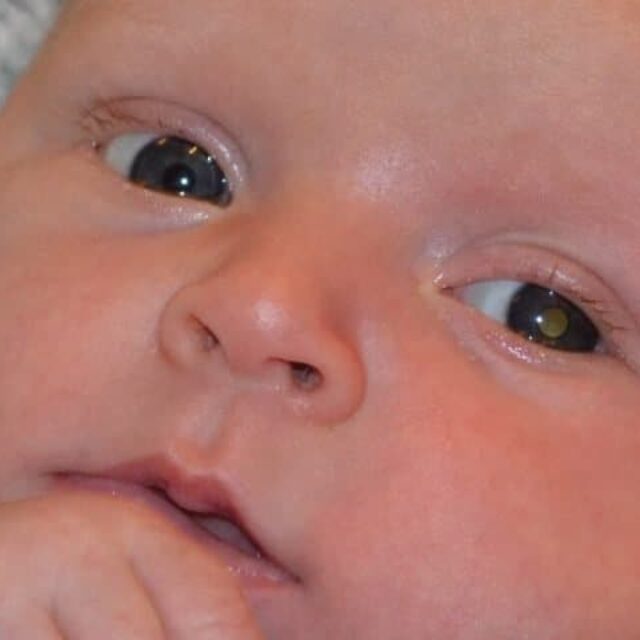 Остаточний діагноз: ретинобластома чи псевдоретинобластома?