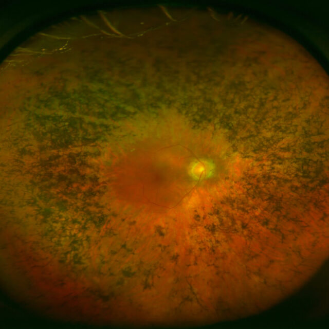 Розробка нового методу лікування втрати зору при пігментному ретиніті