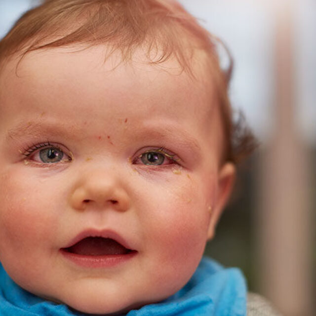 Офтальмологічні прояви мультисистемного запального синдрому, асоційованого із SARS-CoV-2, у дітей