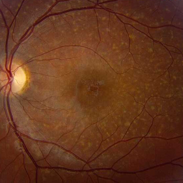 Новий підхід до класифікації хвороби Штаргардта за допомогою штучного інтелекта