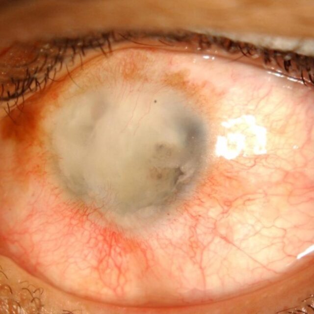 Пост-травматичний ендофтальміт. Частина 3: особливості антибіотикотерапії та покази до хірургічного лікування