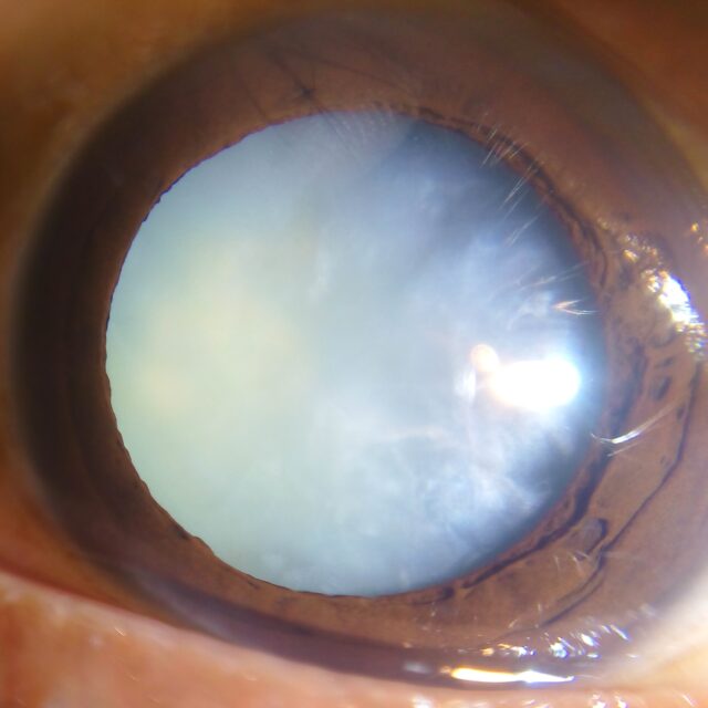 Медикаментозне лікування катаракти стало на крок ближче до реальності