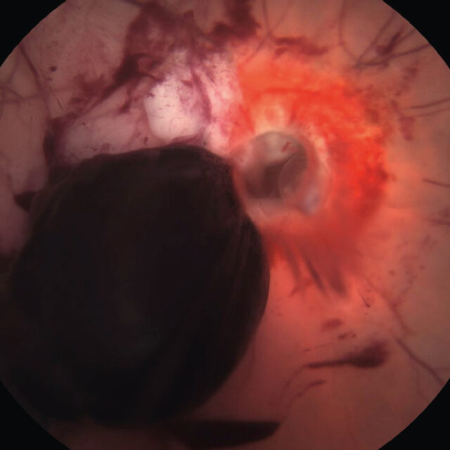 Травматична оптична нейропатія. Частина 2: консервативний та хірургічний підходи до лікування