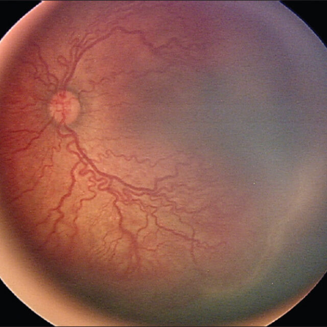 Як впилвають лазерне лікування та інтравітреальне введення бевацизумабу на прогресування міопії у дітей із ретинопатією недоношених