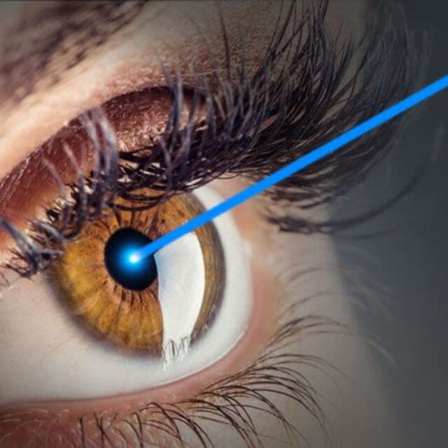 Лазерна рефракційна хірургія для лікування анізометропічної амбліопії у дітей