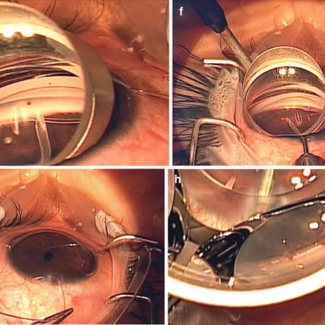 Транслюмінальна трабекулотомія з допомогою гоніоскопії є багатообіцяючим методом лікування міоцилінової глаукоми у дітей