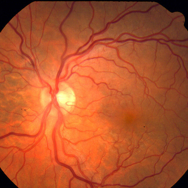 Штучний інтелект виявив, що покручені артерії на сітківці можуть спричинити розвиток хвороб серця