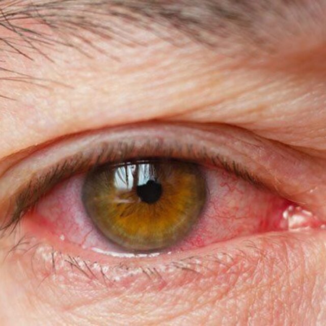 Кілька слів про симптоми, причини та лікування хвороби сухого ока