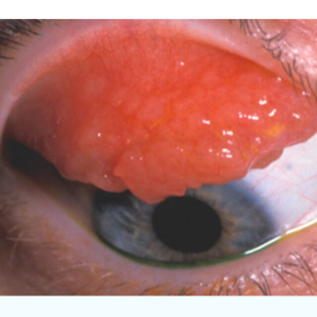 Погана фізична форма у дітей пов’язана зі збільшеними ризиками алергічного кон’юнктивіту