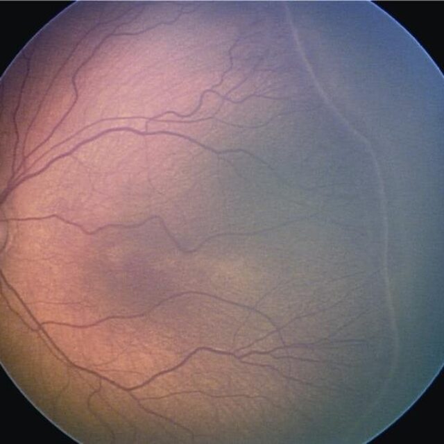 Зв’язок між загрозливими захворюваннями очей та легень недоношених дітей, а також потенційно новий підхід до їх лікування