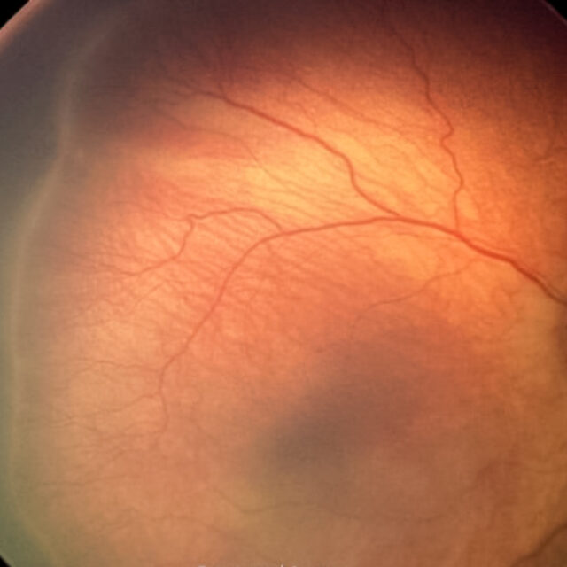 Порівняння ефективності лазерного лікування та анти-VEGF для ретинопатії недоношених через 2 роки після втручання