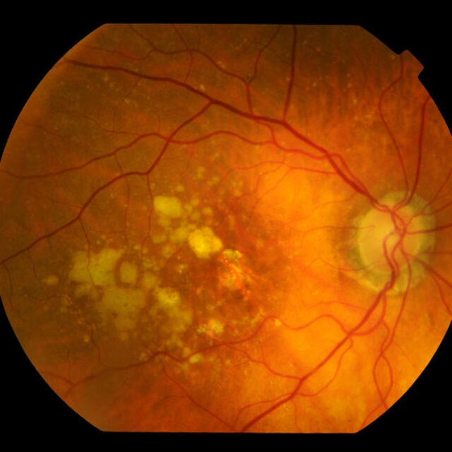 Мелатонін знижує ризики розвитку та сповільнює прогресування вікової макулярної дегенерації