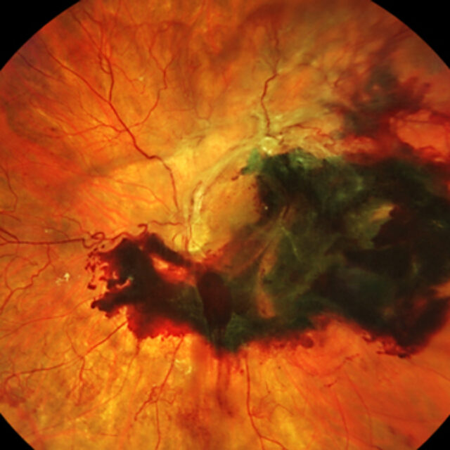 Нове потенційне лікування діабетичної ретинопатії – антикерамідна імунотерапія