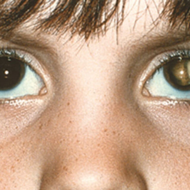 Удосконалення в лікуванні рідкісних онкологічних хвороб ока у дітей