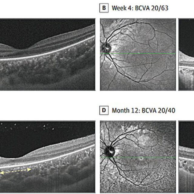 Нове захворювання сітківки у дітей, яке призводить до різкої втрати зору