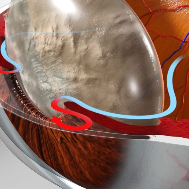 Нова форма ліків, яка в перспективі може замінити щоденне використання крапель для менеджменту глаукоми