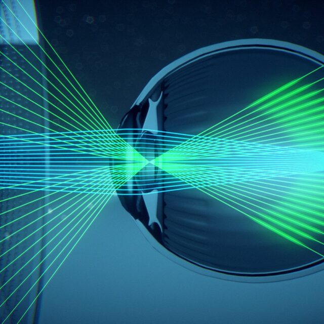 П’ятирічне дослідження підтвердило ефективність високоасферичних лінз (HAL) у контролі прогресування короткозорості в дітей