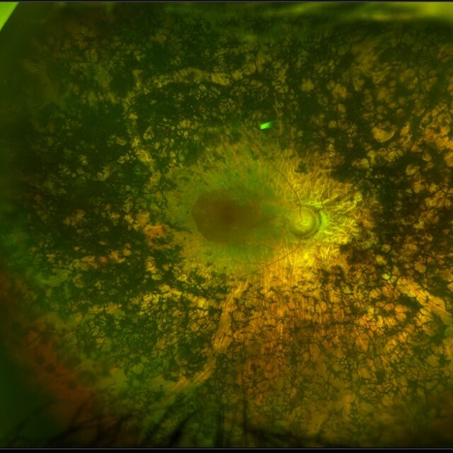 Нові кроки у розробці генетичної терапії для пізніх стадій спадкових дегенерацій сітківки